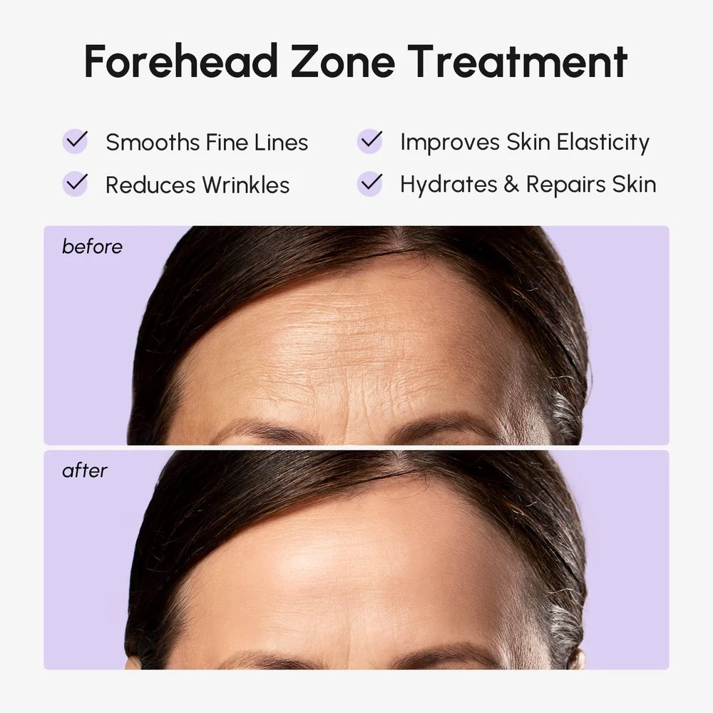 Before and after image showing Anti-Wrinkle Forehead Patches for Women, highlighting smooth fine lines and reduced wrinkles.